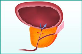 Hypertrophie de la prostate et compression de l'urètre