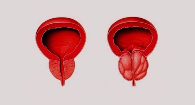 Prostate saine (à gauche) et enflammée par une prostatite (à droite)