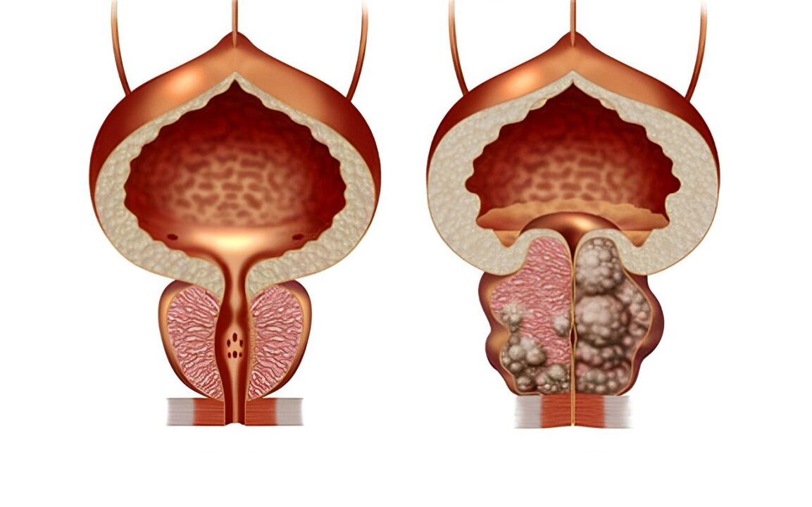 A quoi ressemble l'adénome de la prostate 