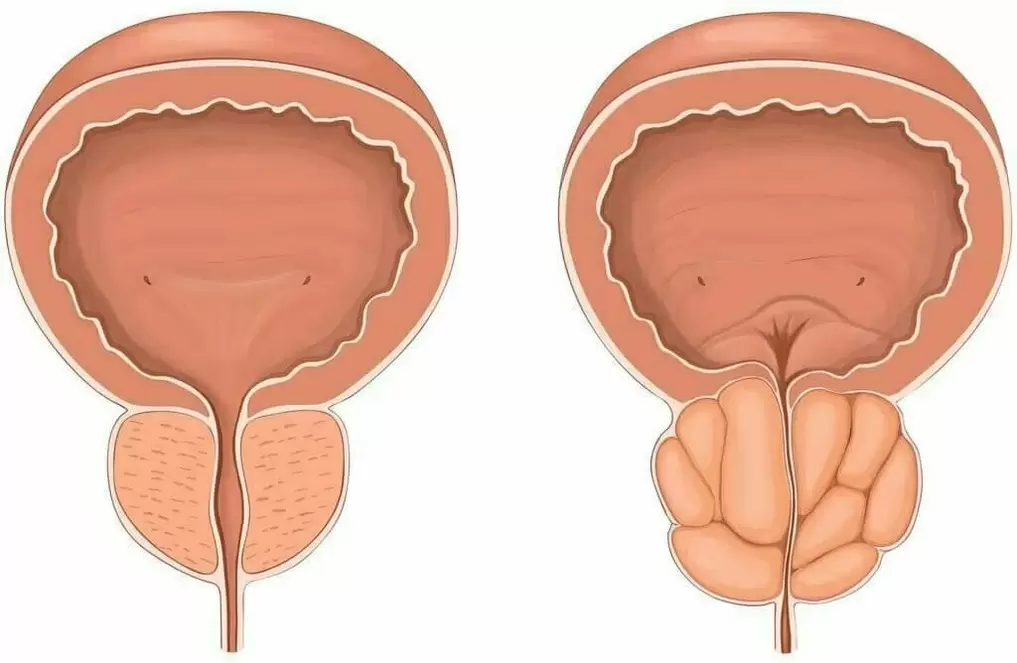 Douleur normale de la prostate et de la prostate